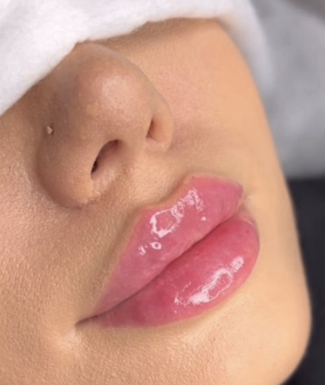 powiększanie ust łódź